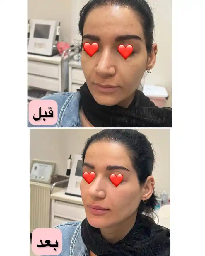 ماندگاری نتایج مادلینگ صورت چقدر است؟