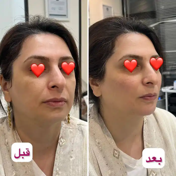 مراحل انجام تزریق ژل مادلینگ صورت به صورت دقیق و گام به گام