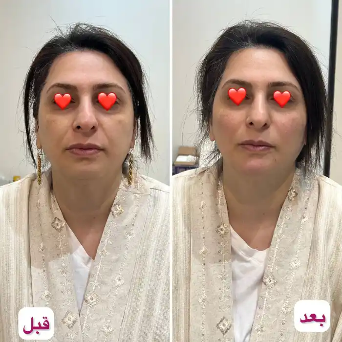 مراحل تزریق ژل برای چروک صورت