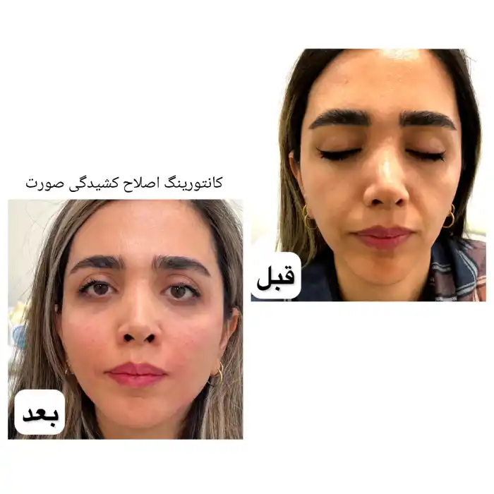 نکات مراقبتی بعد از تزریق ژل رووفیل 1 سی سی