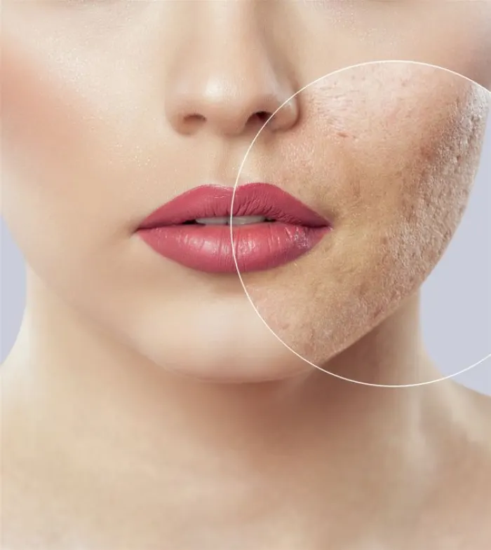 مراقبت های بعد از تزریق ژل به جای جوش صورت