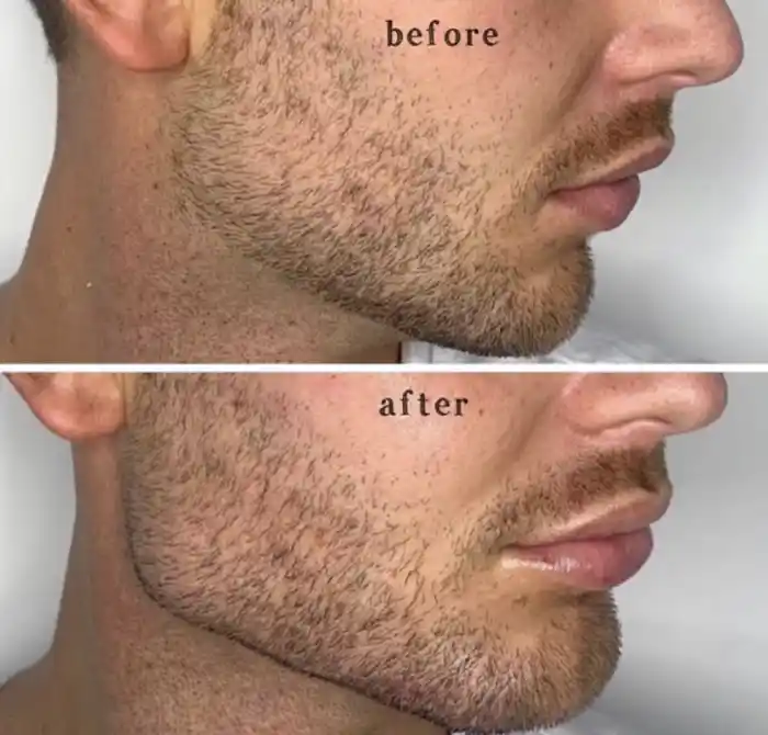 مراقبت های بعد از مادلینگ صورت مردان با تزریق ژل