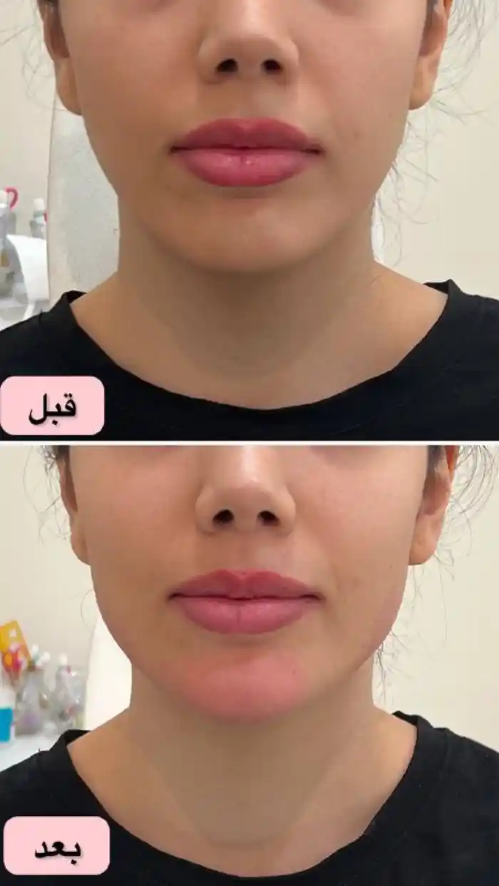 مراقبتهای لازم بعد از مادلینگ صورت چیست؟