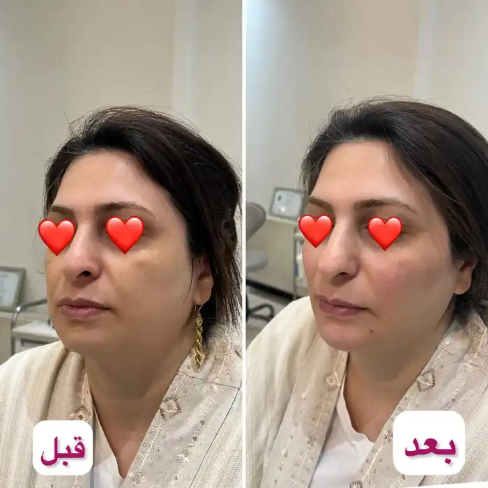 مزایا تزریق ژل برای چروک صورت