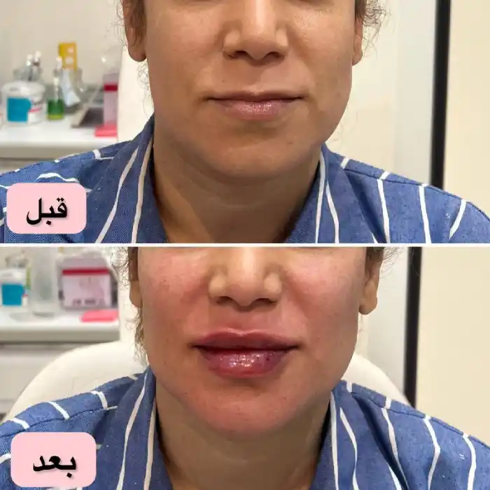 مزایا تزریق ژل مادلینگ صورت و دلیل انجام این کار