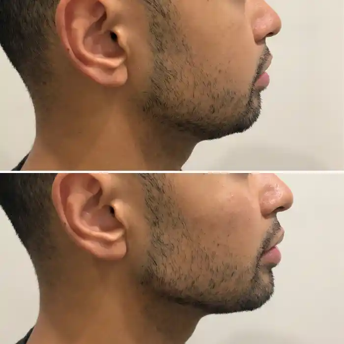 مزایا تزریق ژل چانه مردان و اهمیت آن