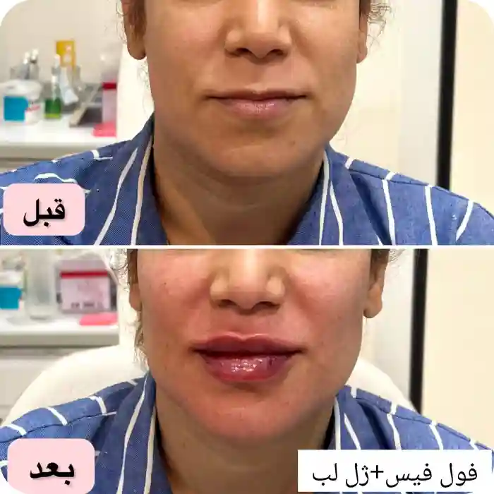 مزایای تزریق ژل برای ماندگاری مادلینگ صورت