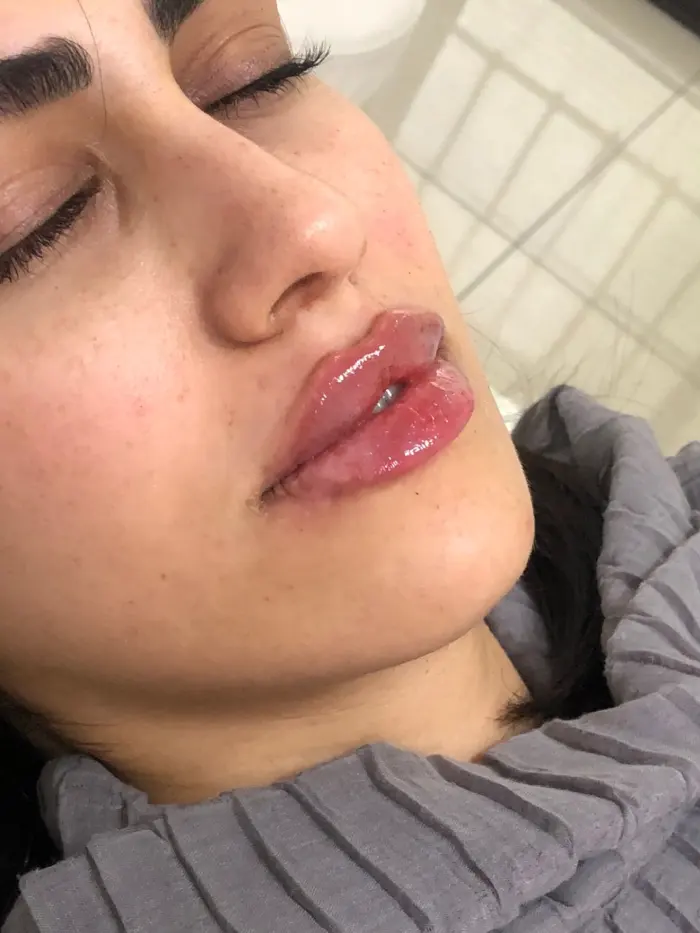 نکات بعد از تزریق ژل الانسه به صورت