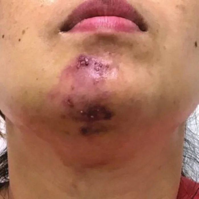 نکروز چانه بعد از تزریق ژل یعنی چی؟