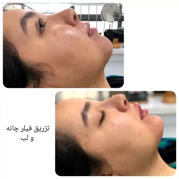 ژل چانه چیست و چه نقشی در زیبایی چهره دارد؟