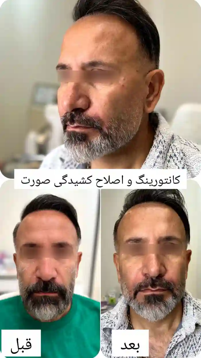 شایع ترین و رایج ترین عوارض مادلینگ صورت