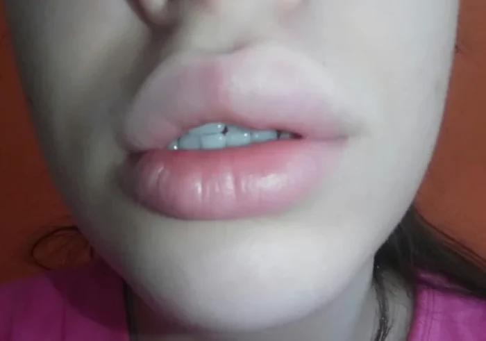 ورم بعد از تزریق ژل چند روز طول می کشد؟