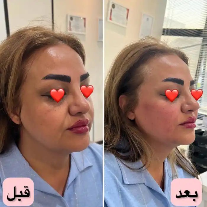 چرا تزریق ژل برای چروک صورت پر طرفدار است