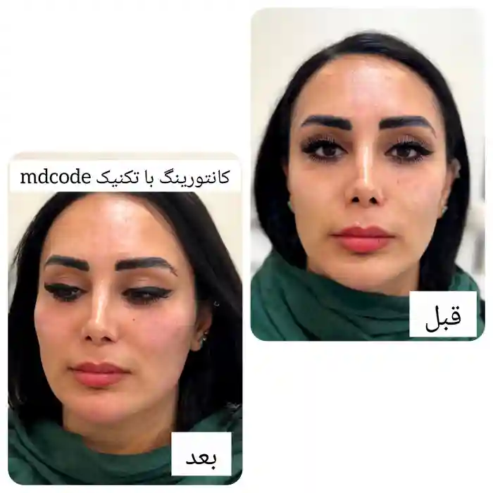 چگونه تشخیص دهیم ژل رووفیل 1 سی سی اصل است؟