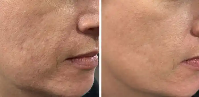 کاربردهای اصلی مزوژل جالپرو در حوزه زیبایی و درمانی