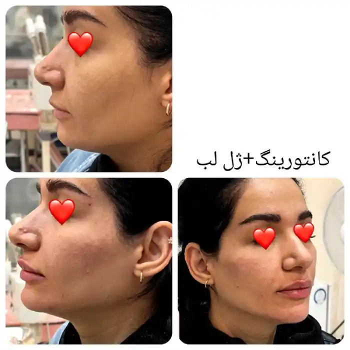 قیمت پکیج مادلینگ صورت ارزان تر از جراحی و مزایا دیگر این روش