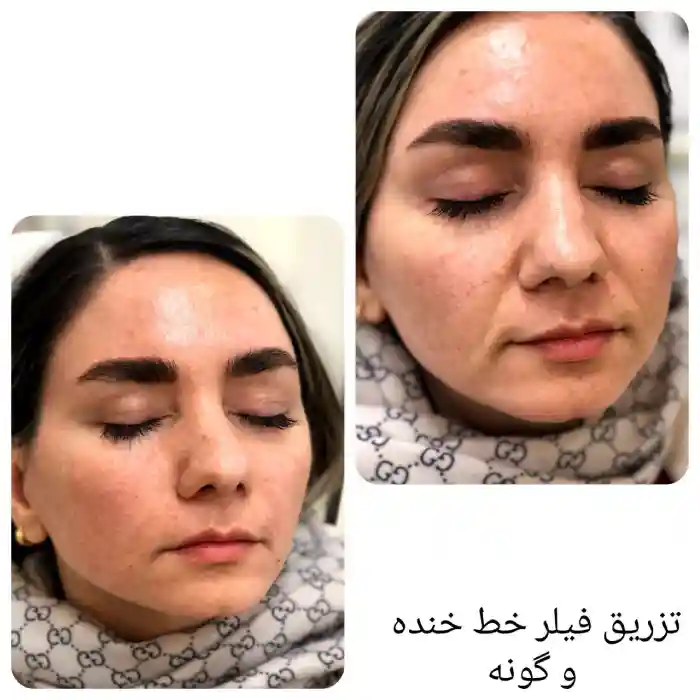 قیمت پکیج مادلینگ صورت و نواحی رایج در تزریق