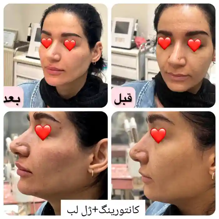 قیمت پکیج مادلینگ صورت، مراحل دقیق انجام پکیج مادلینگ صورت