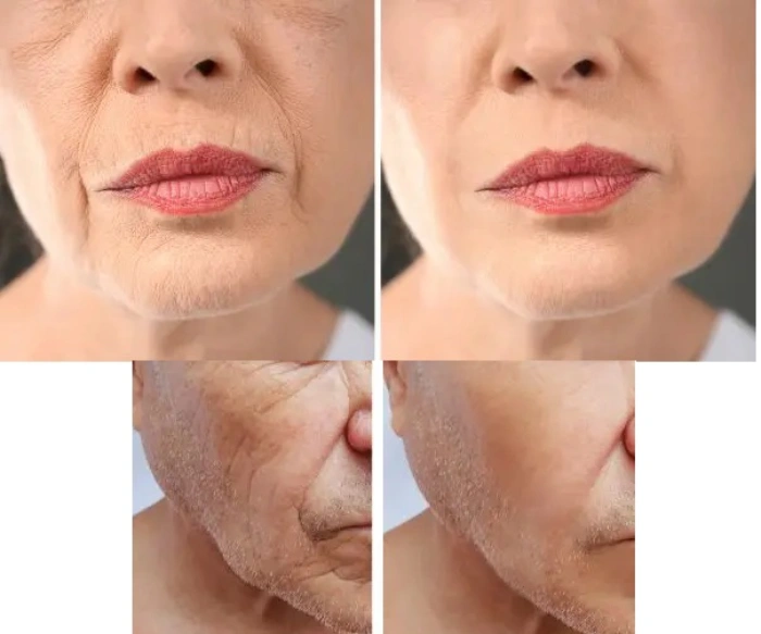 نحوه تزریق مزوژل پروفایلو