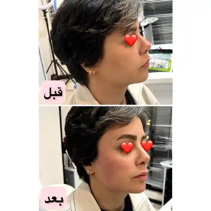 مناسب ترین قیمت پکیج مادلینگ صورت در کرج با ژل 1404