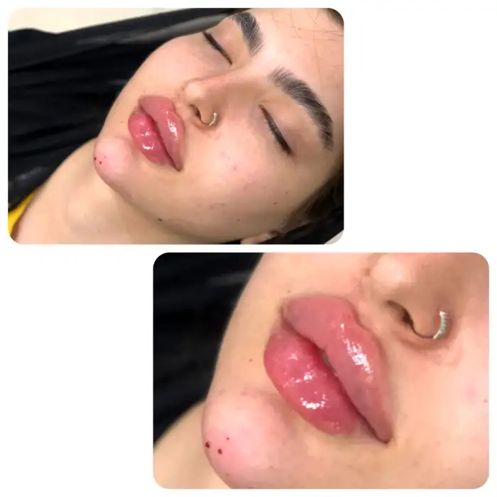 توضیح کامل فرق فیلر لب با ژل لب