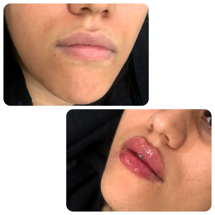 روند تزریق نیم سی سی ژل لب: مراحل و نکات کلیدی