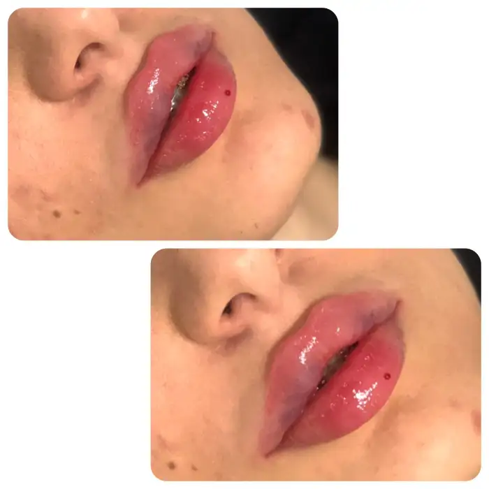 نتایج و ماندگاری نیم سی سی ژل لب