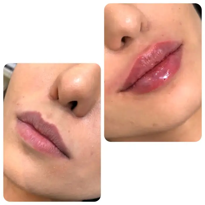 نتیجه گیری نیم سی سی ژل لب
