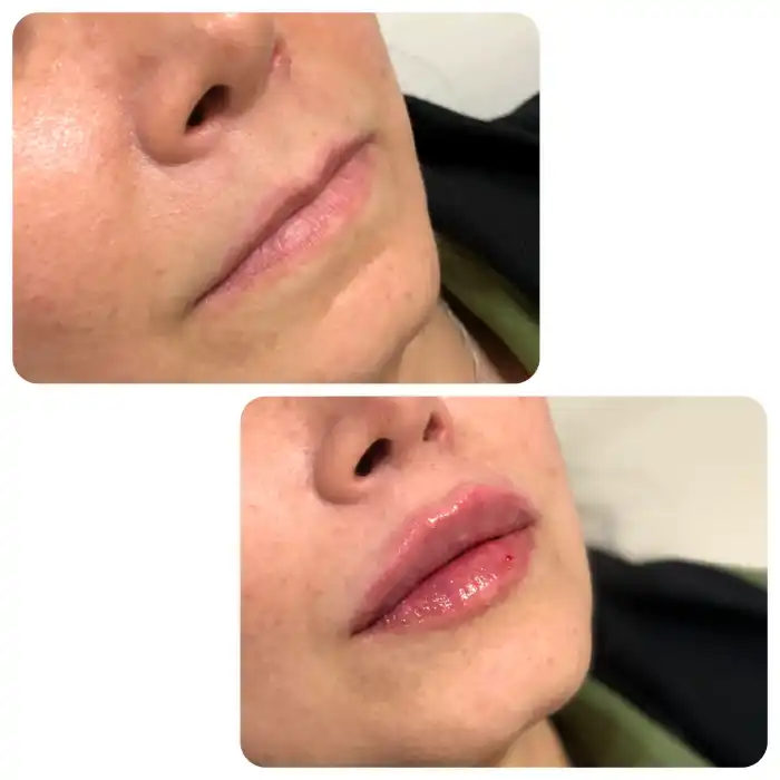 نیم سی سی ژل لب