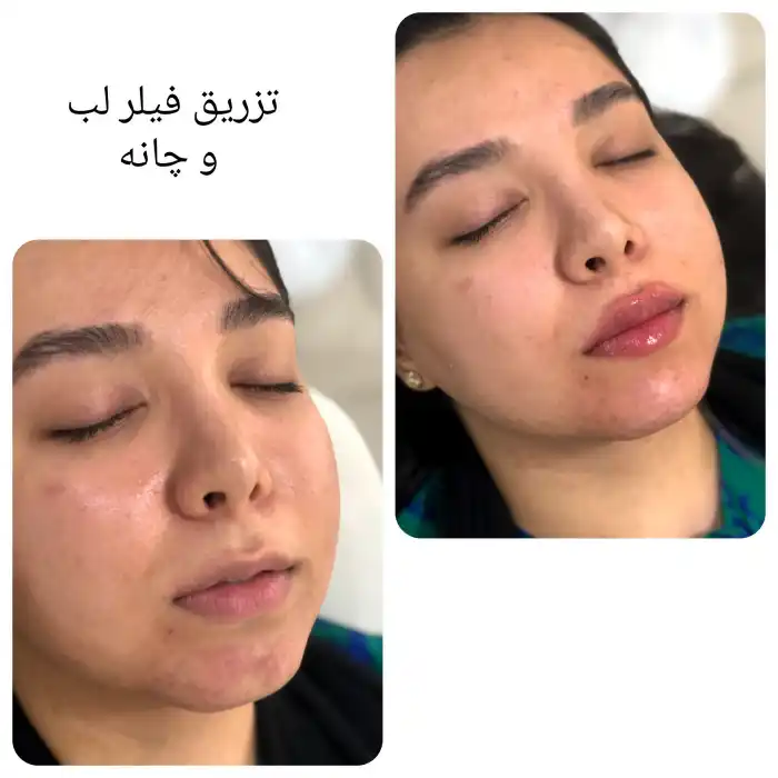 چرا نیم سی سی ژل لب؟